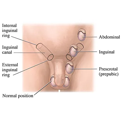 Retrograde intrarenal surgery RIRS